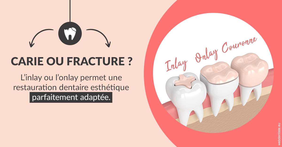 https://dr-robert-philippe.chirurgiens-dentistes.fr/T2 2023 - Carie ou fracture 2