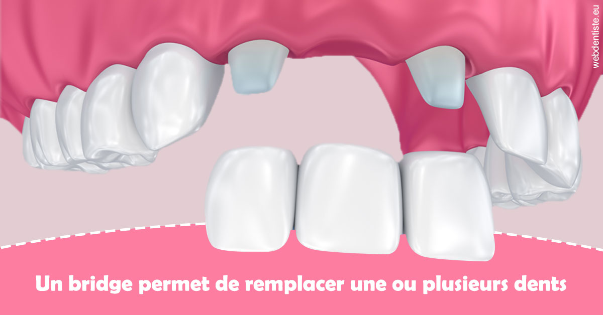 https://dr-robert-philippe.chirurgiens-dentistes.fr/Bridge remplacer dents 2