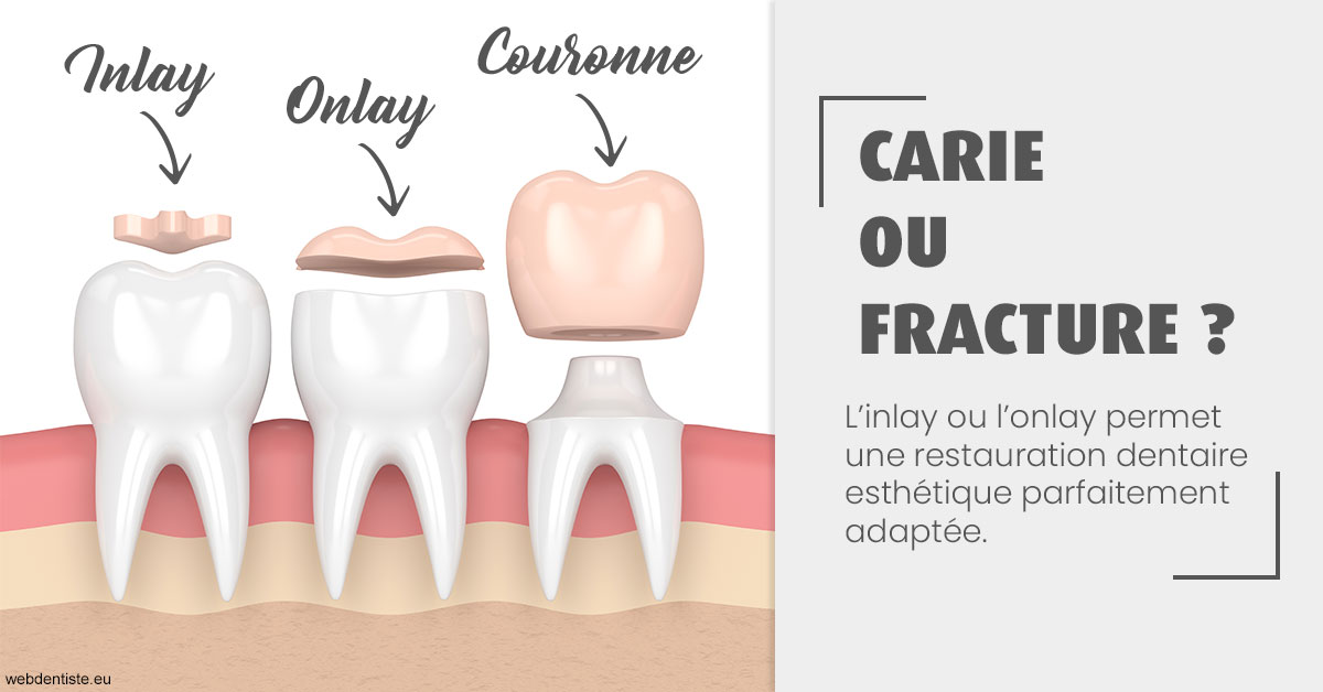 https://dr-robert-philippe.chirurgiens-dentistes.fr/T2 2023 - Carie ou fracture 1