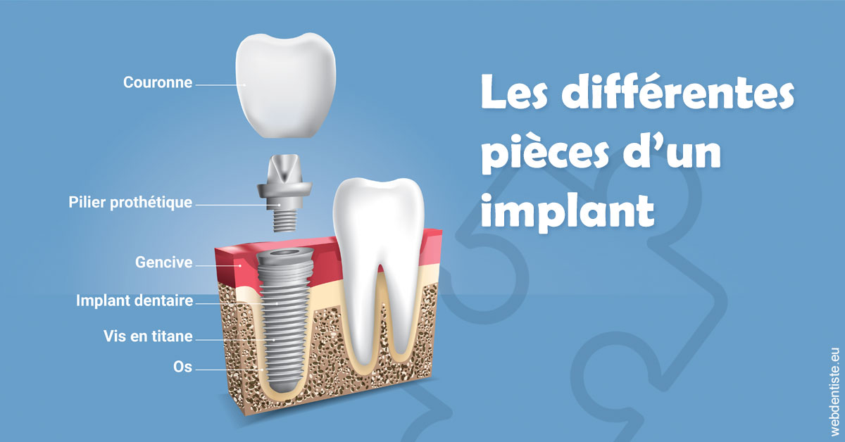 https://dr-robert-philippe.chirurgiens-dentistes.fr/Les différentes pièces d’un implant 1